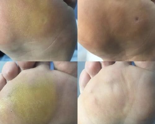 Гиперкератоз. Виды. Лечение гиперкератоза в Киеве
